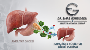 Ameliyat öncesi karaciğer küçültme diyetinde tüketilen düşük kalorili besinler